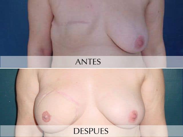 Antes y Después Microcirugía DIEP