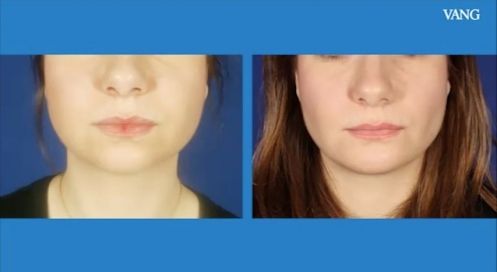 Corregir las bolas de Bichat