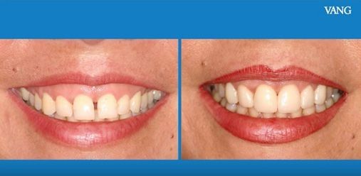 ¿Cómo corregir la sonrisa gingival?