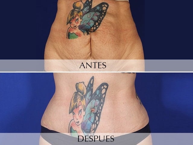 Cuerpo tonificado, vista frontal de abdomen post-cirugía