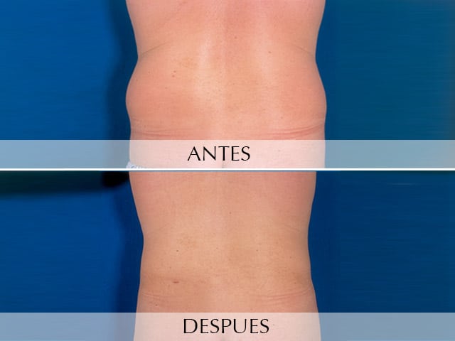 Antes y Después Liposucción