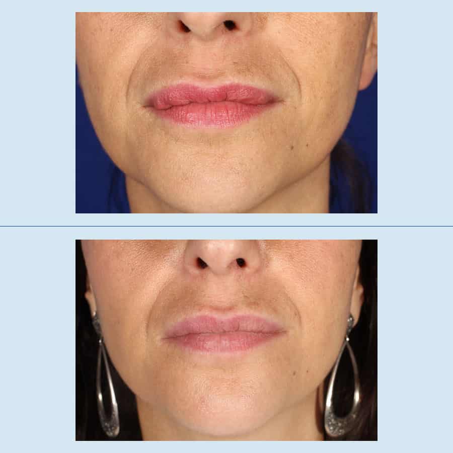 Antes y Después Eliminar Rellenos Faciales