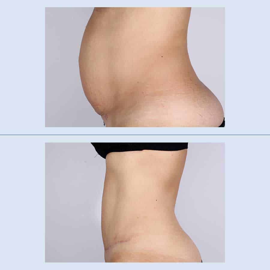Antes y Después Abdominoplastia
