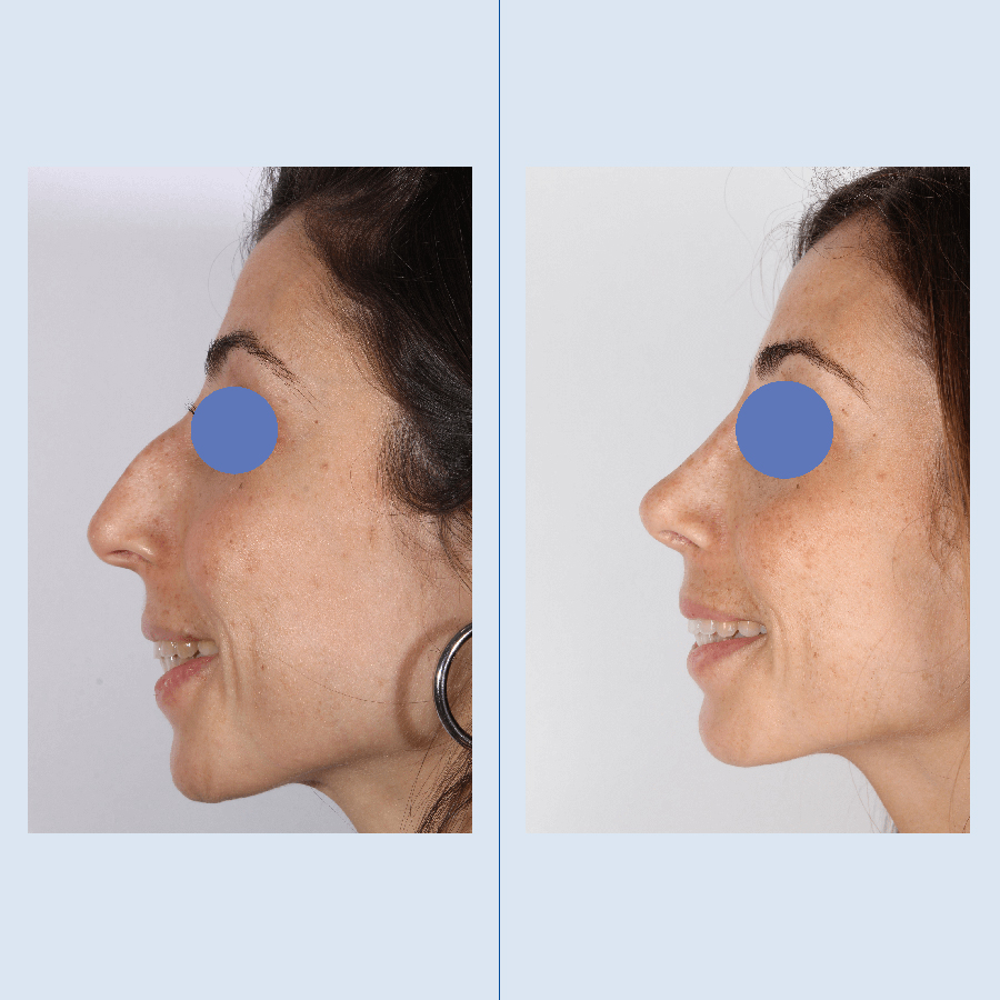 Antes y Después Cirurgía del nas