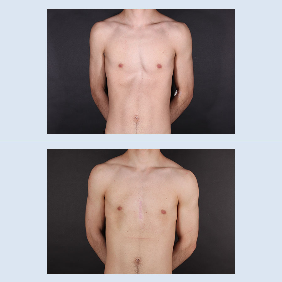 Antes y Después Pectus Excavatum