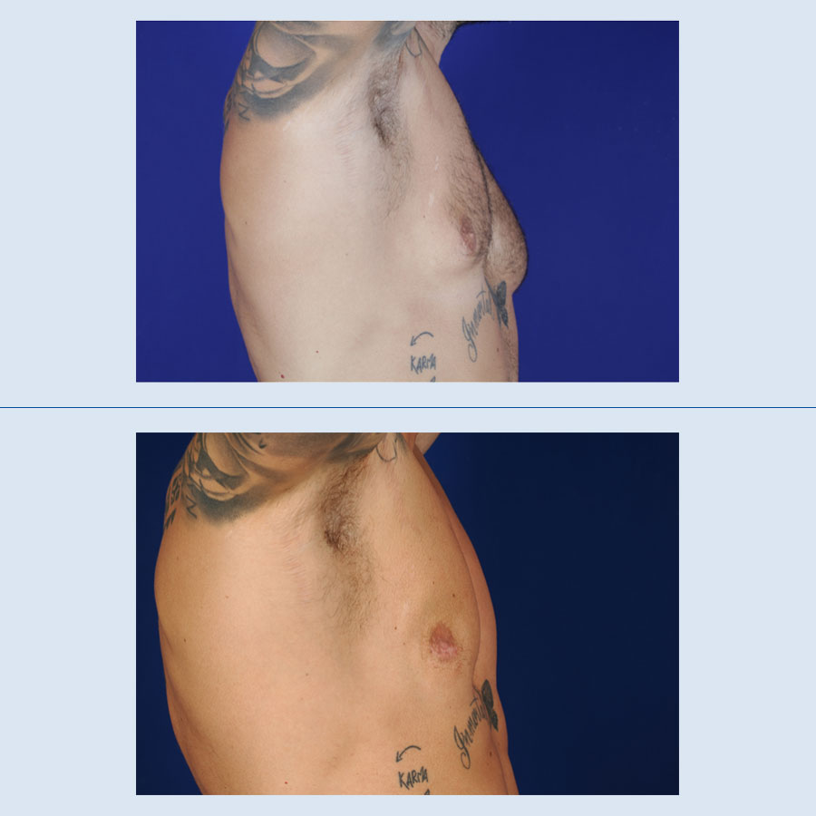 Antes y Después Ginecomastia