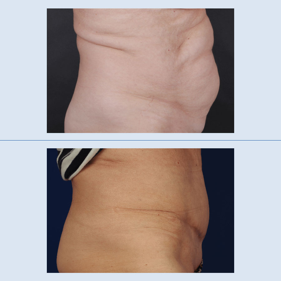 Contorno corporal mejorado con resultados de abdominoplastia