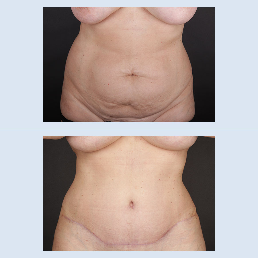 Abdominoplastia: vista frontal de los resultados del paciente