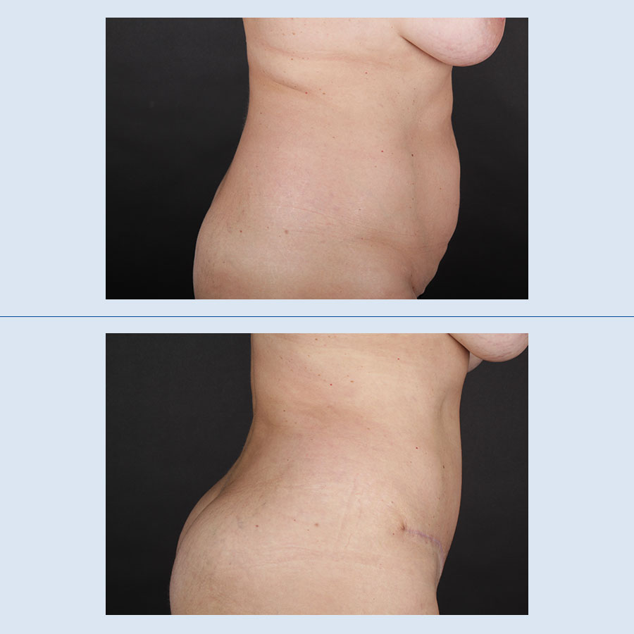 Perfil del paciente con resultados de la cirugía de abdomen