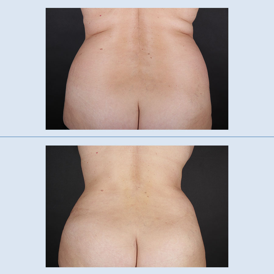 Antes y después de abdominoplastia, reducción de contorno