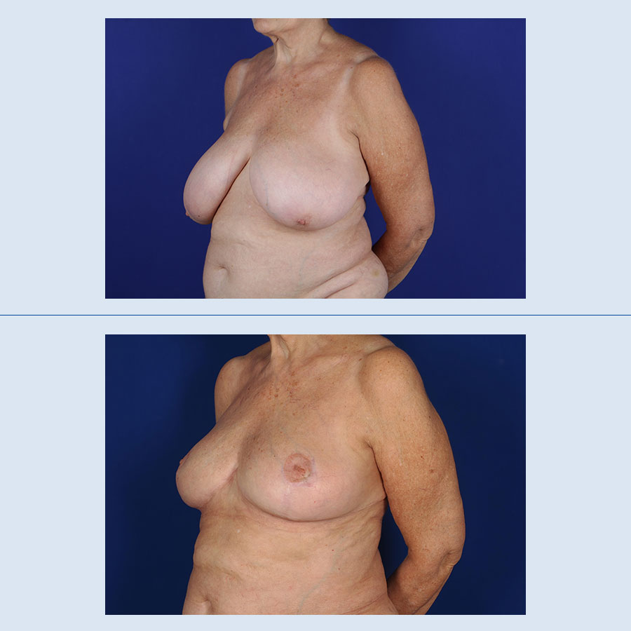 Antes y Después Breast Reduction