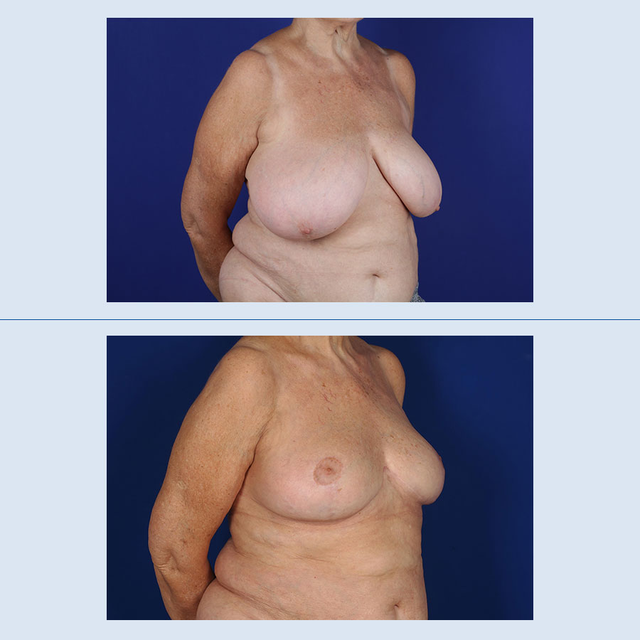 Antes y Después Breast Reduction
