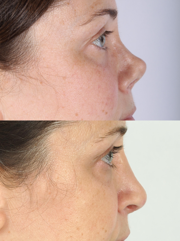 Reconstrucción de tabique nasal antes y después