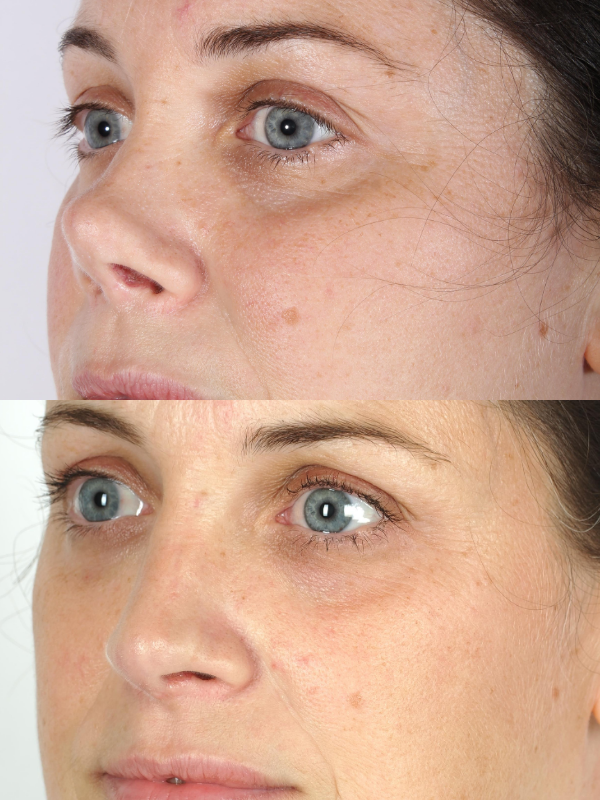 Reconstrucción de tabique nasal antes y después