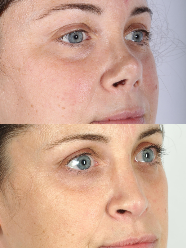 Reconstrucción de tabique nasal antes y después