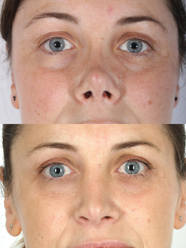 Reconstrucción de tabique nasal antes y después