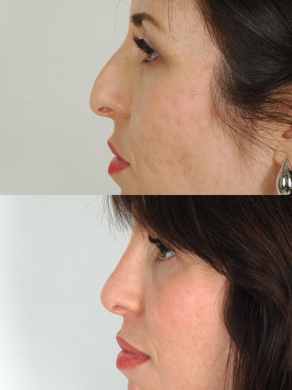 Operación de Nariz  antes y después