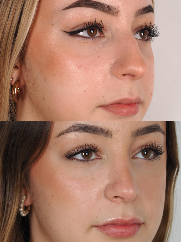 Operación de Nariz  antes y después