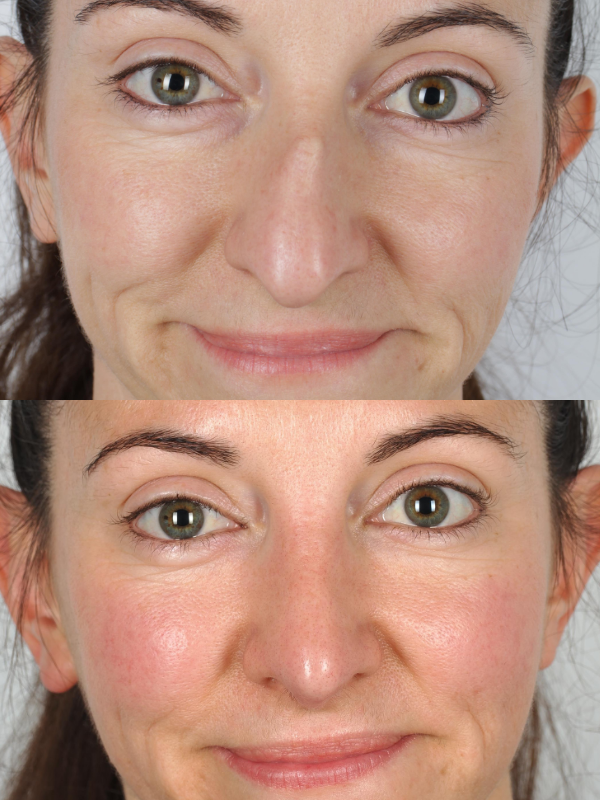 Operación de Nariz  antes y después