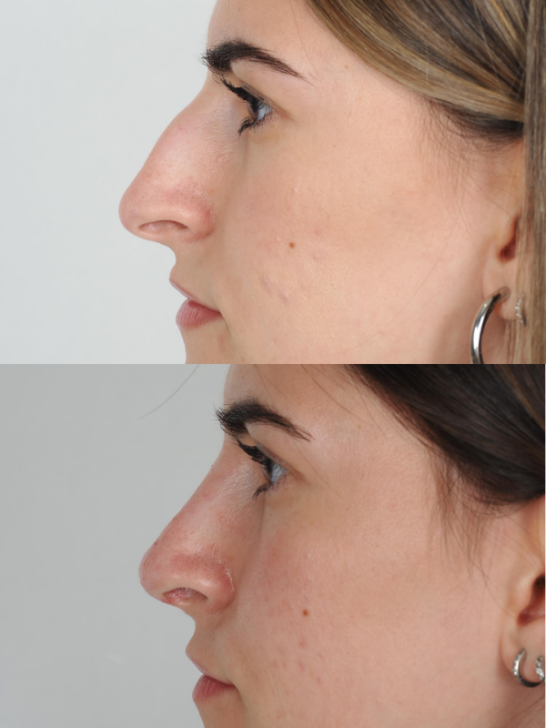 Operación de Nariz  antes y después