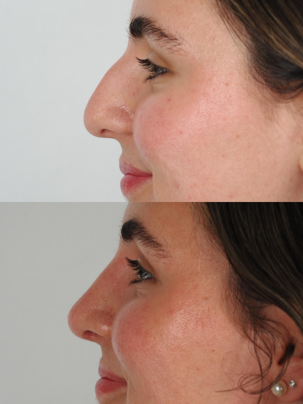 Operación de Nariz  antes y después