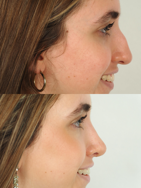 Operación de Nariz  antes y después