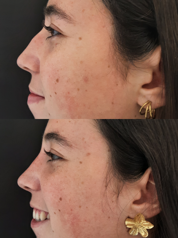 Operación de Nariz  antes y después