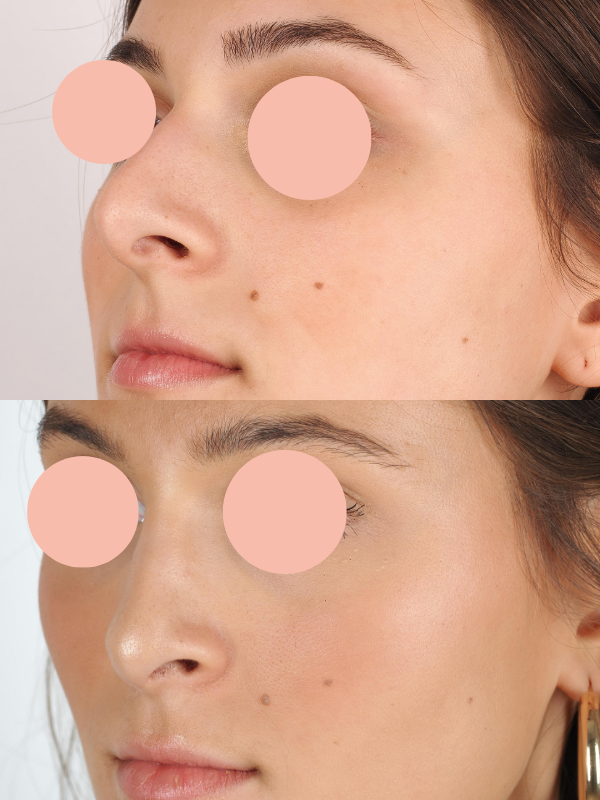 Rinoplastia antes y después