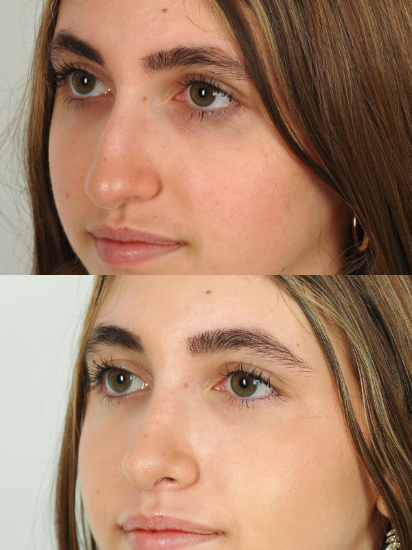 Rinoplastia Ultrasónica antes y después