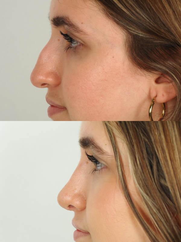 Rinoplastia Ultrasónica antes y después