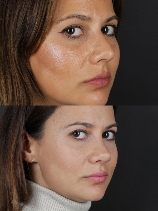 Rinoplastia Ultrasónica antes y después