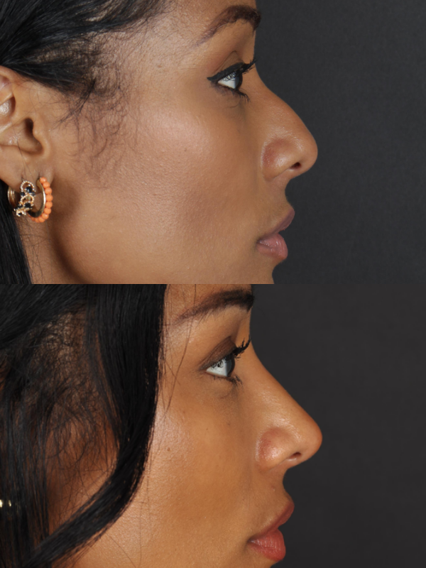 Rinoplastia Ultrasónica antes y después