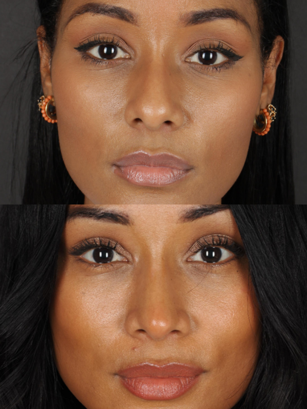 Rinoplastia Ultrasónica antes y después