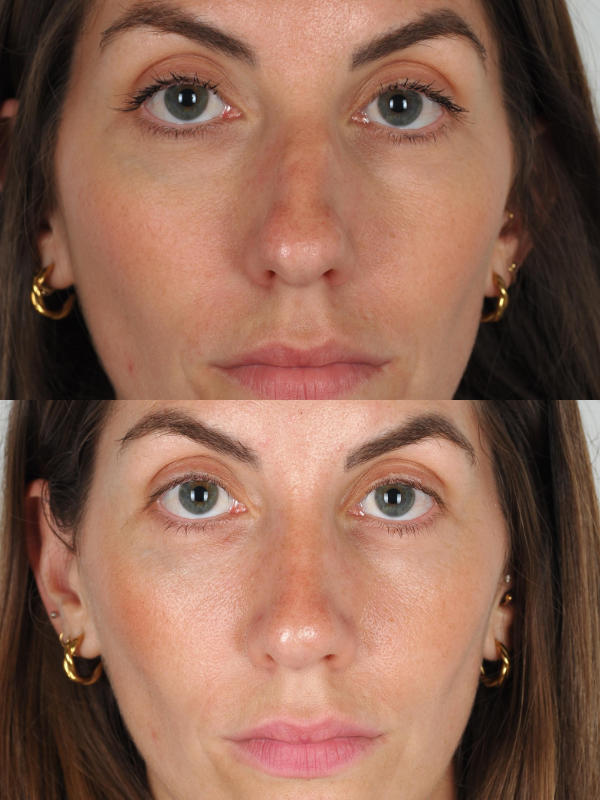 Rinoplastia Ultrasónica antes y después