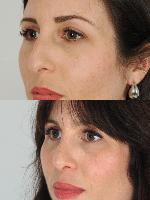 Rinoplastia Ultrasónica antes y después