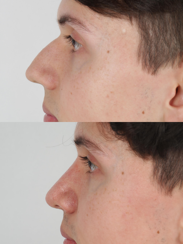 Rinoplastia antes y después