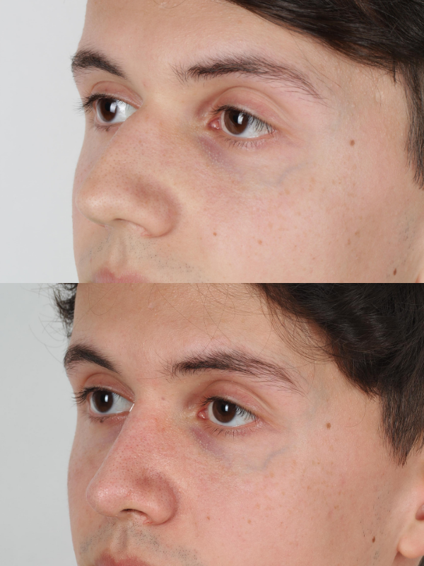 Rinoplastia antes y después