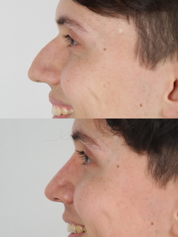 Rinoplastia antes y después