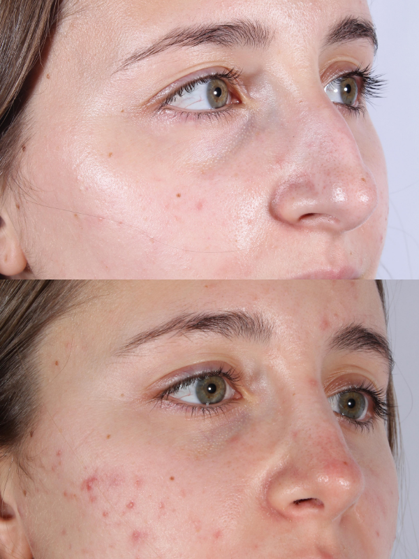 Rinoplastia antes y después