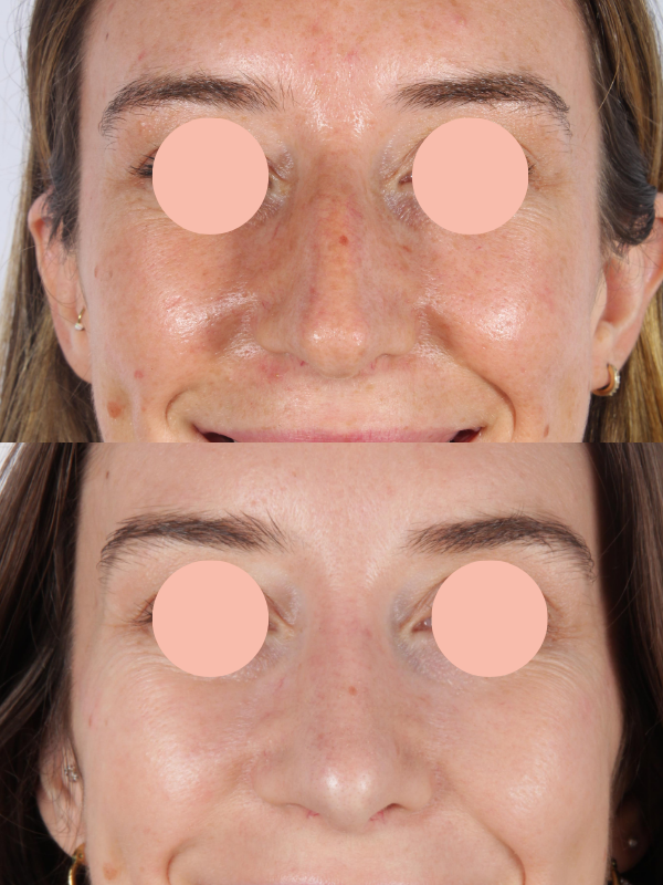 Rinoplastia antes y después