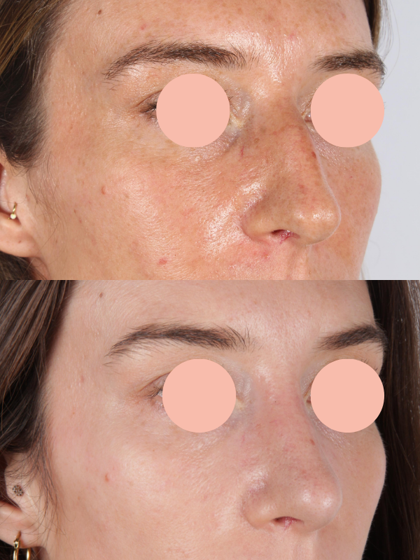 Rinoplastia antes y después