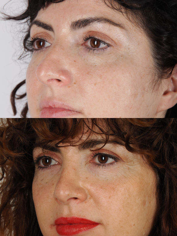 Rinoplastia antes y después