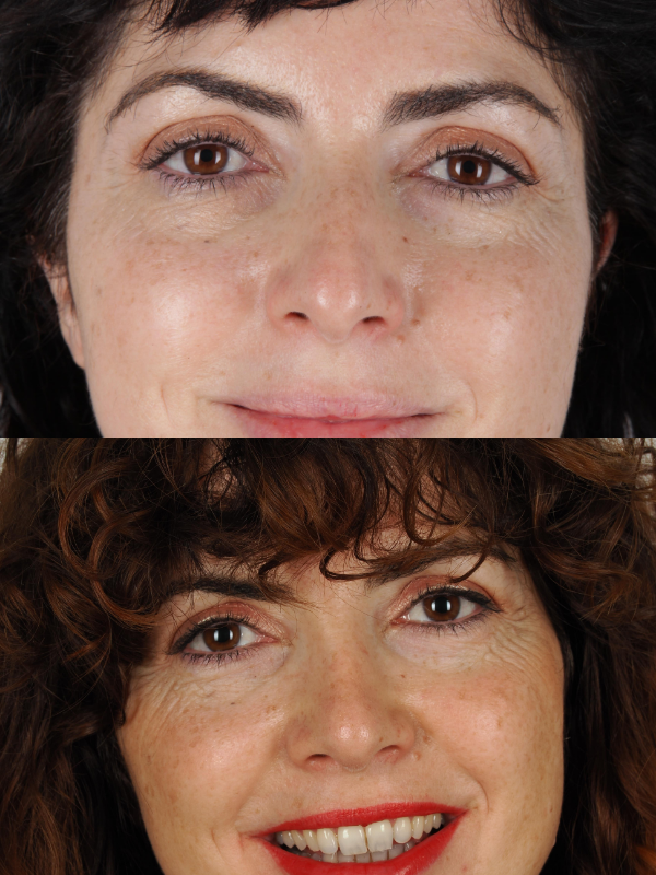 Rinoplastia antes y después