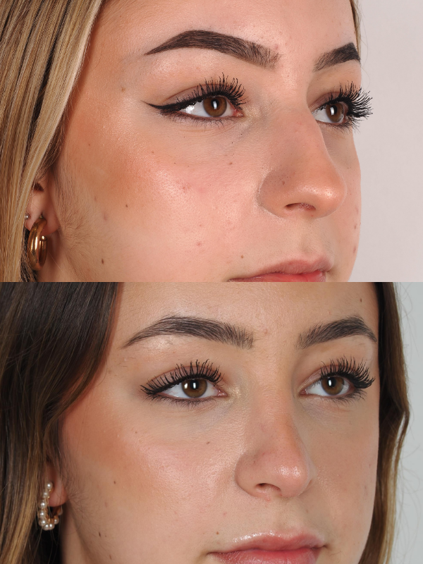 Rinoplastia antes y después